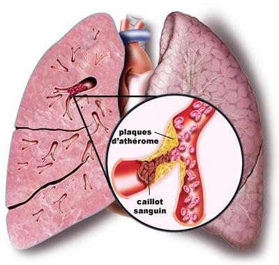 Schéma embolie pulmonaire