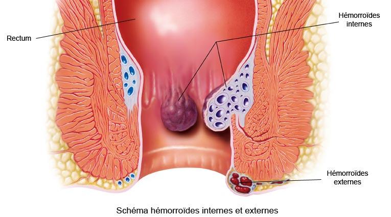 Hémorroïde interne et externe