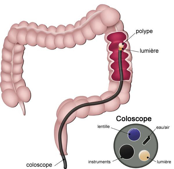 schéma d'une coloscopie