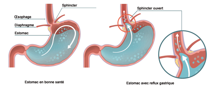 schéma estomac RGO