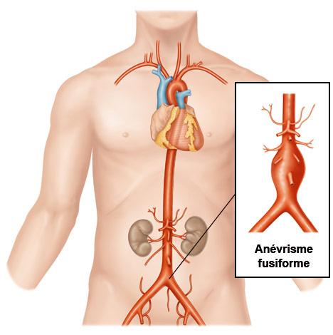 anévrisme fusiforme