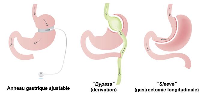 différentes techniques de chirurgie bariatrique