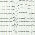 électro-encéphalogramme