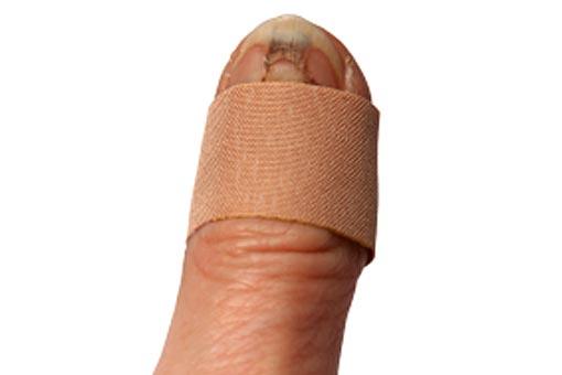 Ongle incarné, cassé ou retourné