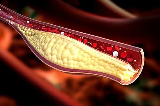 Cholestérol (excès)