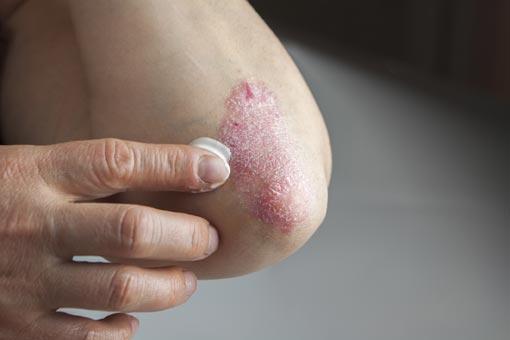 Psoriasis