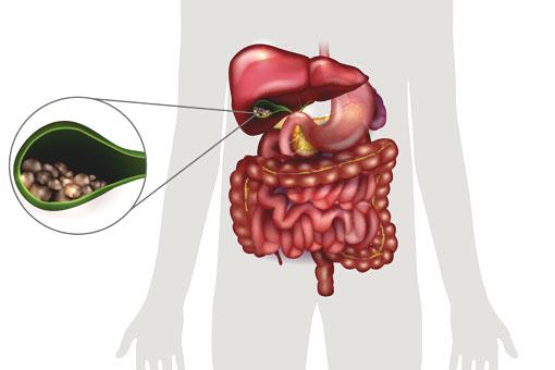 Calculs biliaires