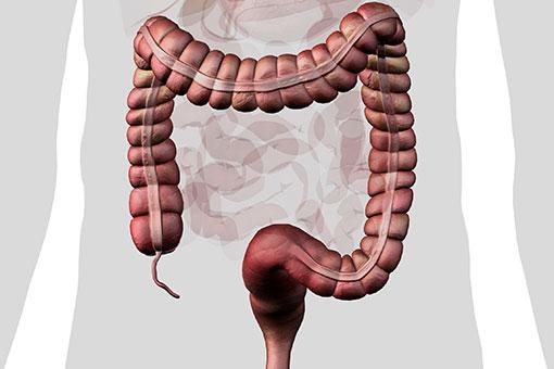 Diverticulose et diverticulite du côlon