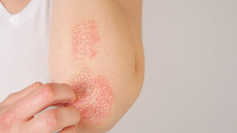 <p>Le psoriasis en plaques est la forme de psoriasis la plus fréquente (80 % des cas).</p>