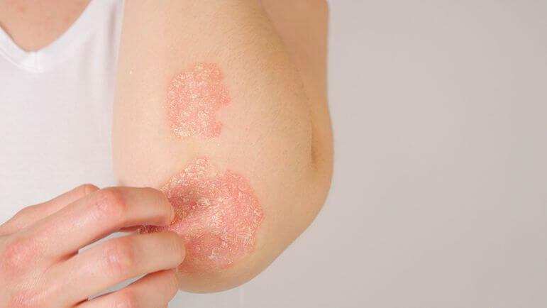 Plusieurs indications chez l'adulte, dont le psoriasis en plaques modéré à sévère.