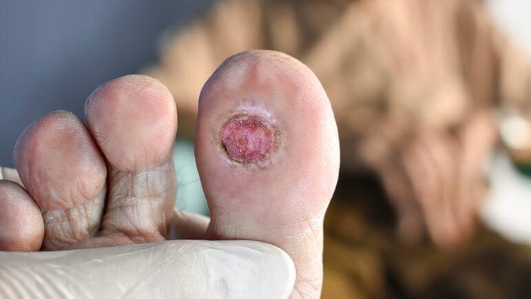 <p>De 15 à 25 % de diabétiques auront une plaie du pied infectée au cours de leur vie.</p>