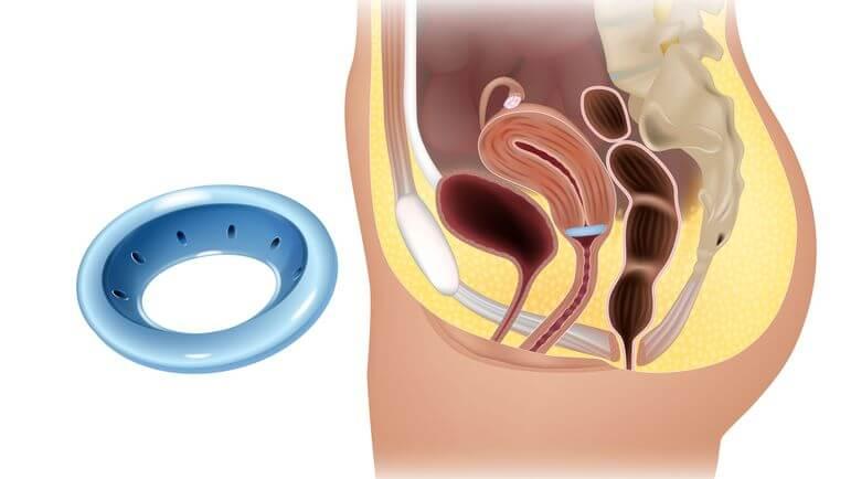 <p>Le pessaire est un dispositif médical intravaginal invasif destiné à soutenir les organes pelviens.</p>