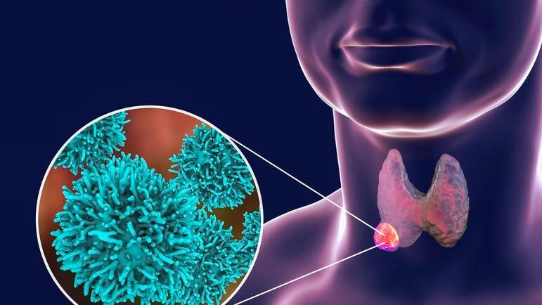 <p>Types histologiques de cancers de la thyroïde : une forme différenciée dans plus de 90 % des cas.</p>