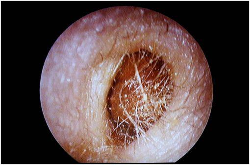 Bouchon de cérumen obstruant la lumière du conduit auditif externe (illustration @Didier Descouens, sur Wikimedia).