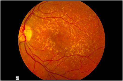Fond d'oeil montrant une DMLA de stade intermédiaire (photo @ National Eye Institute of the NIH sur Wikimedia).