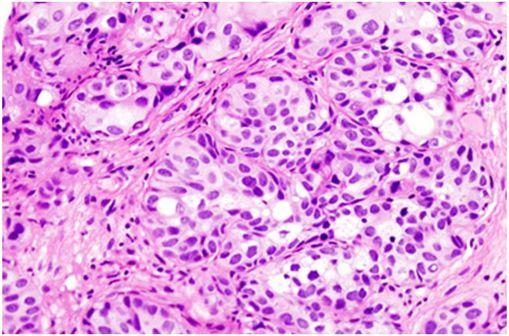 Carcinome urothélial de la vessie de stade pT1 (cliché @ Wikimedia).