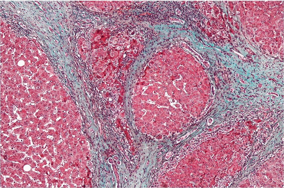 Agrandissement de septa fibreux chez un patient atteint de cirrhose alcoolique (cliché @ Nephron, Wikimedia). 