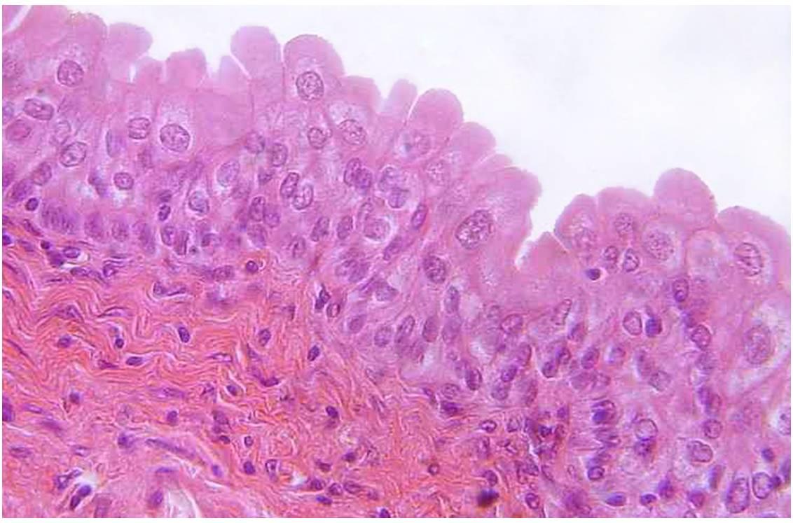 Coupe histologique d'un cancer de la vessie (photo @ Wikimedia).