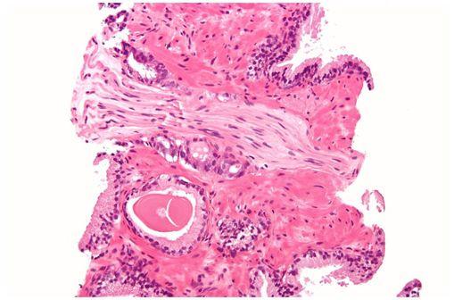 Invasion périneurale par un adénocarcinome prostatique (photo @ Nephron sur Wikimedia).