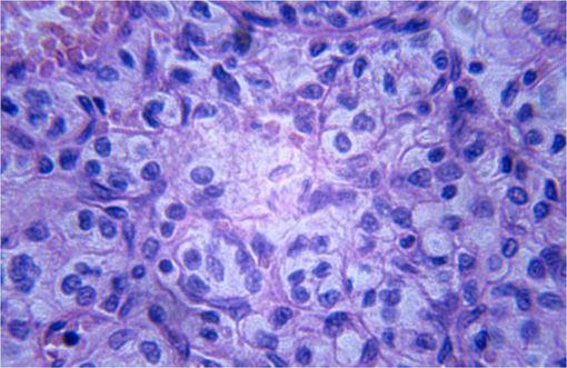 Carcinome rénal (cliché microscopique).