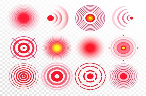 Les douleurs neuropathiques s’expriment par des sensations de brûlure, de froid, de décharge électrique, parfois associées à des fourmillements, picotements, engourdissements et surtout à une hypoesthésie, voire une anesthésie dans le même territoire (ill