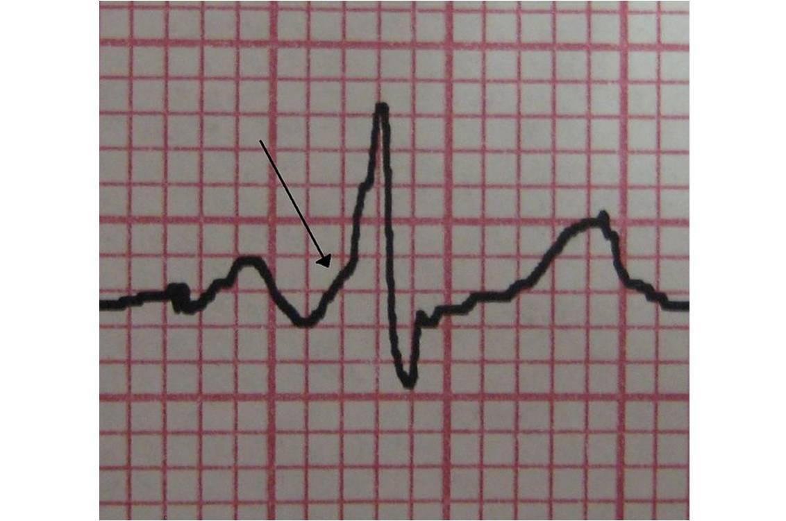 Onde delta caractéristique captée chez un sujet présentant un syndrome de Wolff-Parkinson-White (James Heilman, MD, Wikimedia)