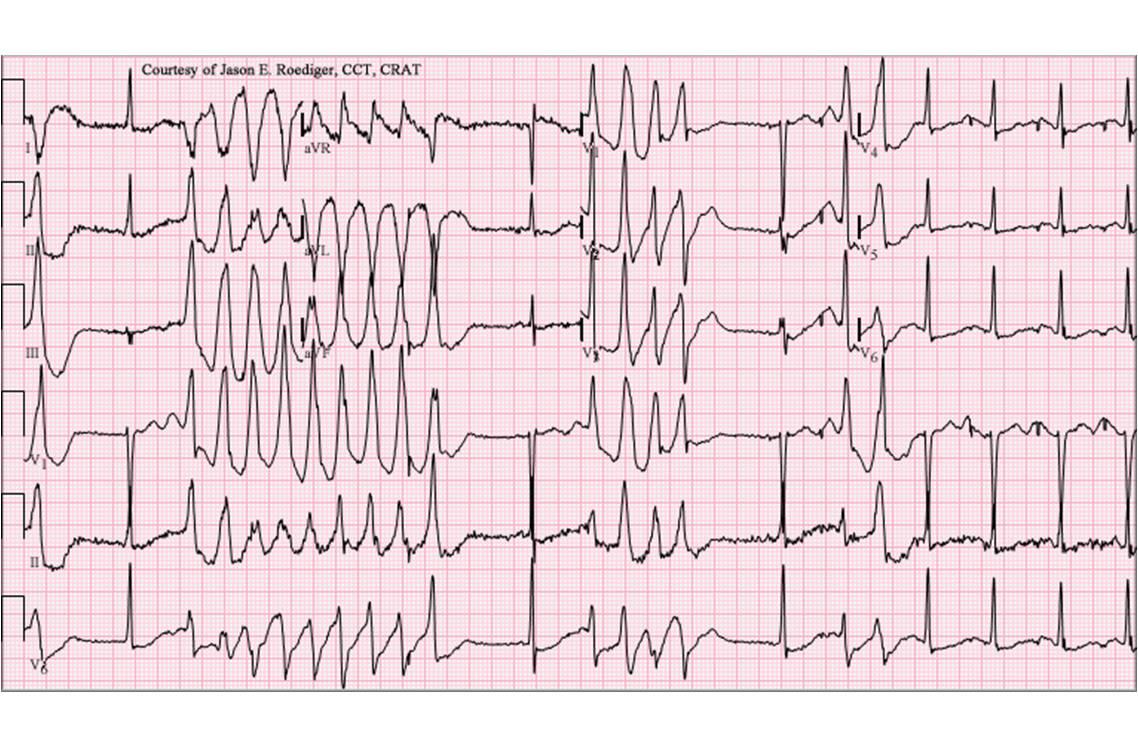 Electrocardiogramme montrant un allongement des espaces QT et captant des torsades de pointe (image : @ Jer5150, Wikimedia).