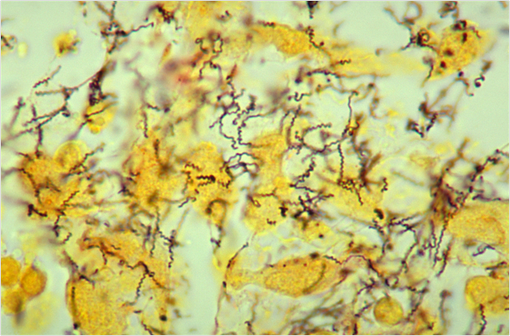 Histopathologie de spirochètes de Treponema pallidum utilisant une coloration argentique modifiée de Steiner (illustration @CDC/Dr Edwin P. Ewing, Jr. 1986).