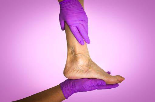 Les ulcères veineux sont variqueux (post-thrombotiques) dans 50 % des cas, ou dus à une insuffisance veineuse chronique, chez les personnes âgées particulièrement (illustration).