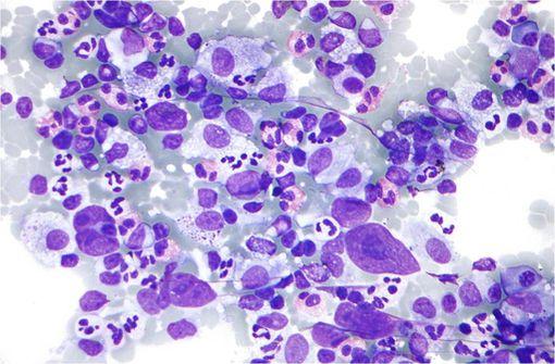 Préparation histologique montrant un lymphome de Hodgkin (éosinophiles, cellules de Reed-Sternberg, cellules plasmatiques, histiocytes) [cliché @ Wikimedia].