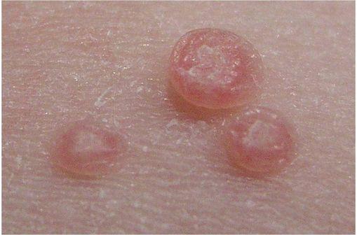 Le Molluscum contagiosum réalise une lésion épidermique cratériforme (illustration @ Evanherk de nl sur Wikimedia).