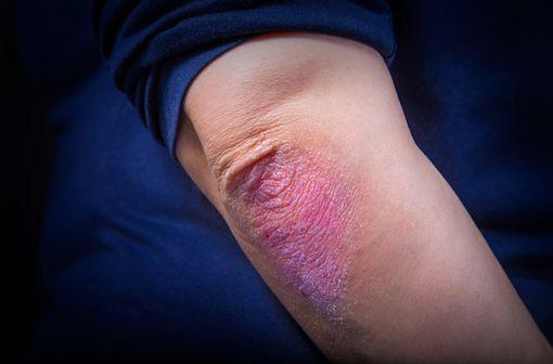 Lésion de psoriasis localisée au coude (illustration).
