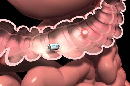 La HAS publie son évaluation de la Pillcam dans l'exploration du côlon