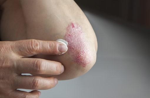 Plaque de psoriasis.