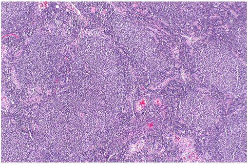 Micrographie montrant un lymphome à cellules B, compatible avec un lymphome folliculaire (illustration @Nephron, sur Wikimedia).