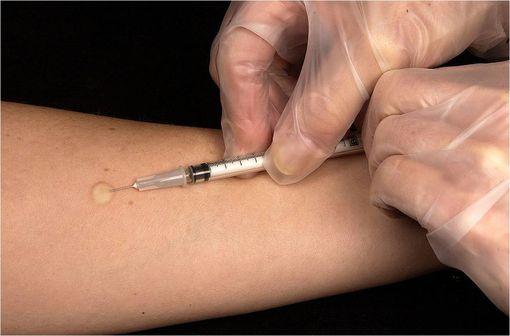 Intradermoréaction à la tuberculine ou test Mantoux, pour le dépistage de la tuberculose (illustration @ Greg Knobloch, CDC, sur Wikimedia).