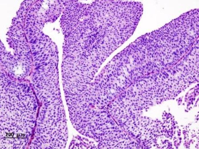 Histopathologie d'un carcinome urothélial de la vessie. Biopsie transurétrale (© KGH, Wikimedia).