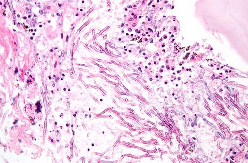 <p>Aspergillose pulmonaire (illustration @Nephron, Wikimedia).</p>