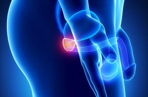 La leuproréline est notamment utilisée dans la prise en charge de cancers de la prostate (illustration).