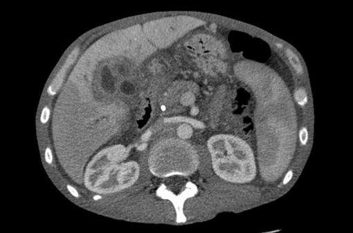 <p>Tomodensitométrie montrant un cholangiocarcinome (illustration @Samir, Wikimedia).</p>