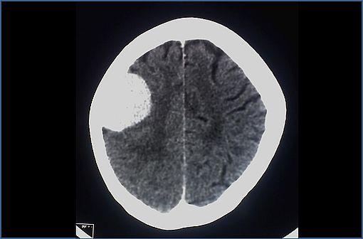 Tomodensitométrie du cerveau montrant un méningiome (illustration @Glitzy queen00 sur Wikimedia)