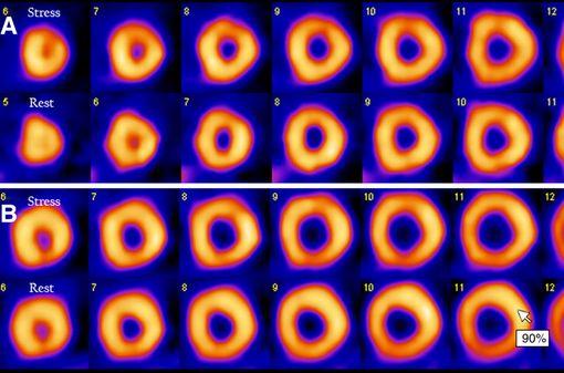 Le régadénoson est un vasodilatateur coronarien sélectif utilisé pour effectuer des scintigraphies de perfusion myocardique (illustration, ref infra). 
