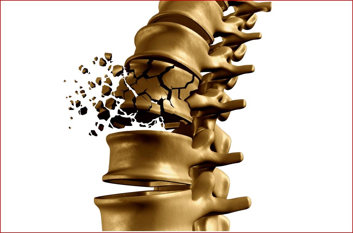 <p>Représentation en 3D d'une fracture vertébrale.</p>