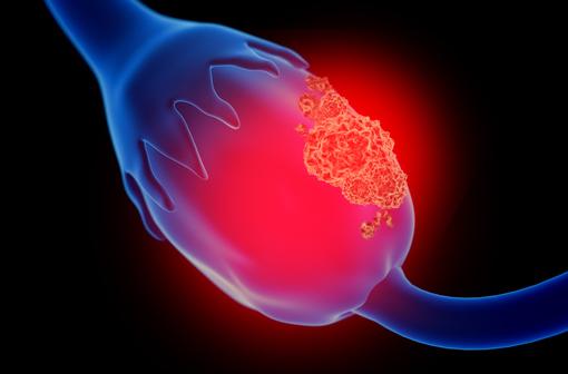 <p>Le cancer de l'ovaire est en général de mauvais pronostic, car découvert souvent tardivement. </p>